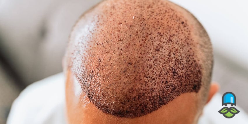 مراحل کاشت مو چگونه انجام می‌شود؟